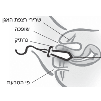 SensaTONE לחיזוק רצפת האגן
